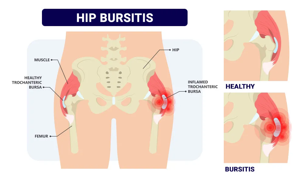 HIP JOINT PAIN FORMULA - hip dysplasia , arthritis or other osteoarthritis