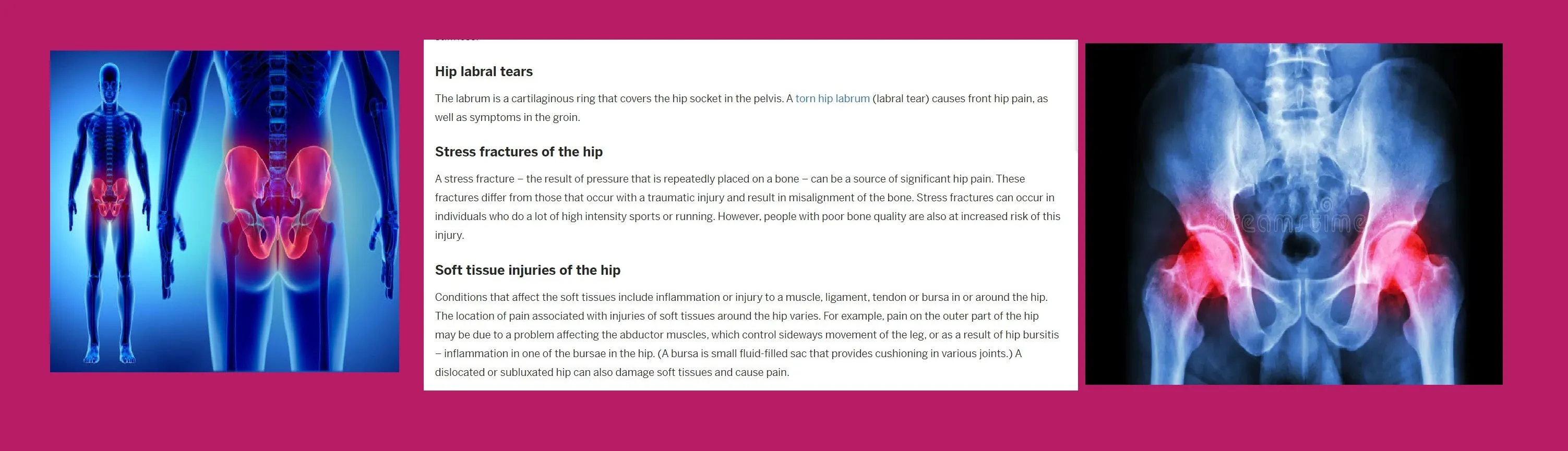 HIP JOINT PAIN FORMULA - hip dysplasia , arthritis or other osteoarthritis